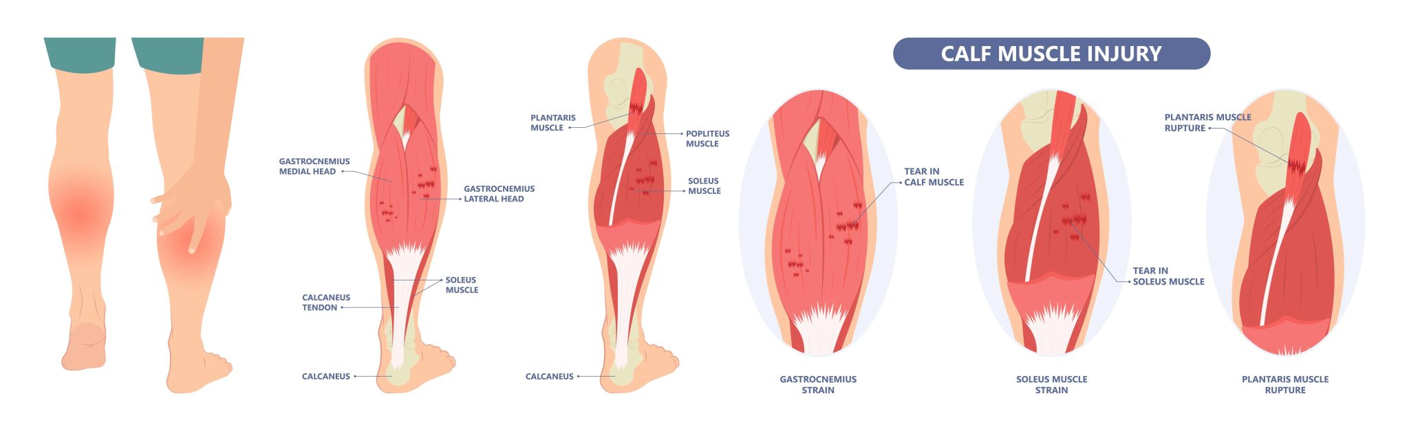 Ankle Injuries in Soccer - Rehab 49