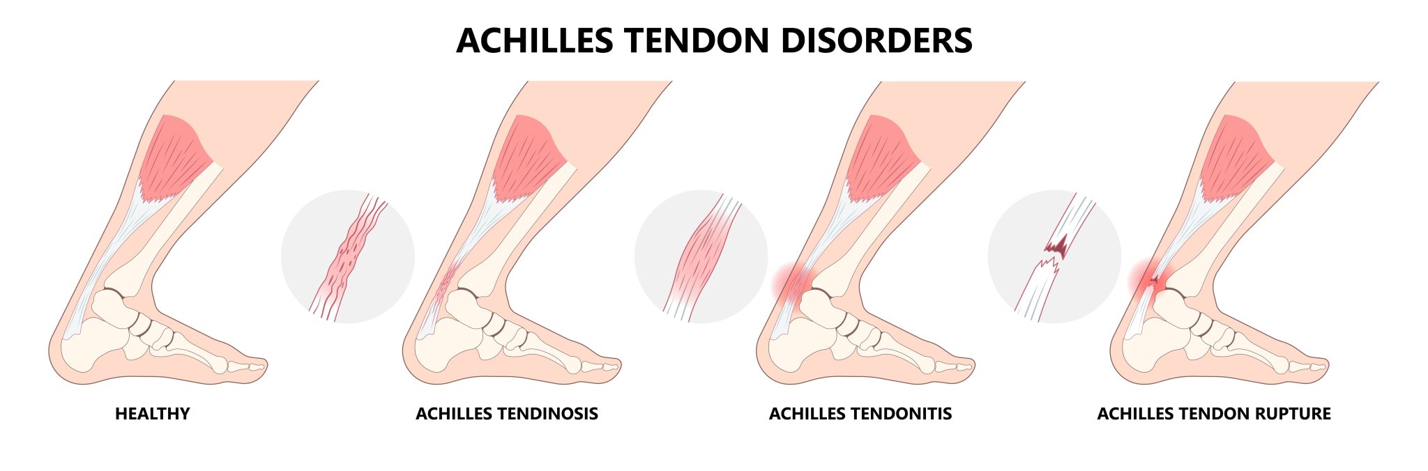 Physical Therapy for Achilles Tendonitis - Rehab 49